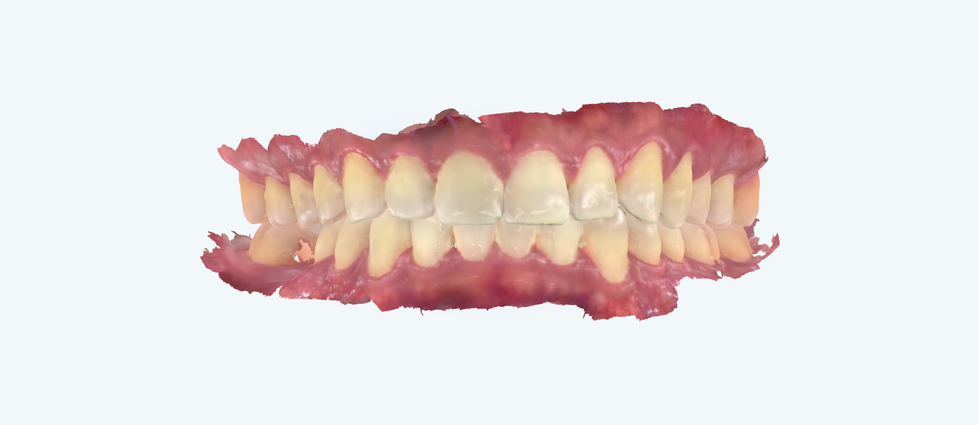 Overbite treatment comparison case 3 after
